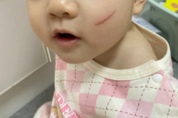 幼兒擦傷藥膏推薦與護理攻略：告別留疤與紅藥水，教你濕潤療法